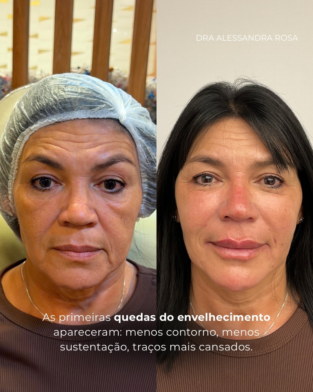 As primeiras quedas do envelhecimento — antes e depois