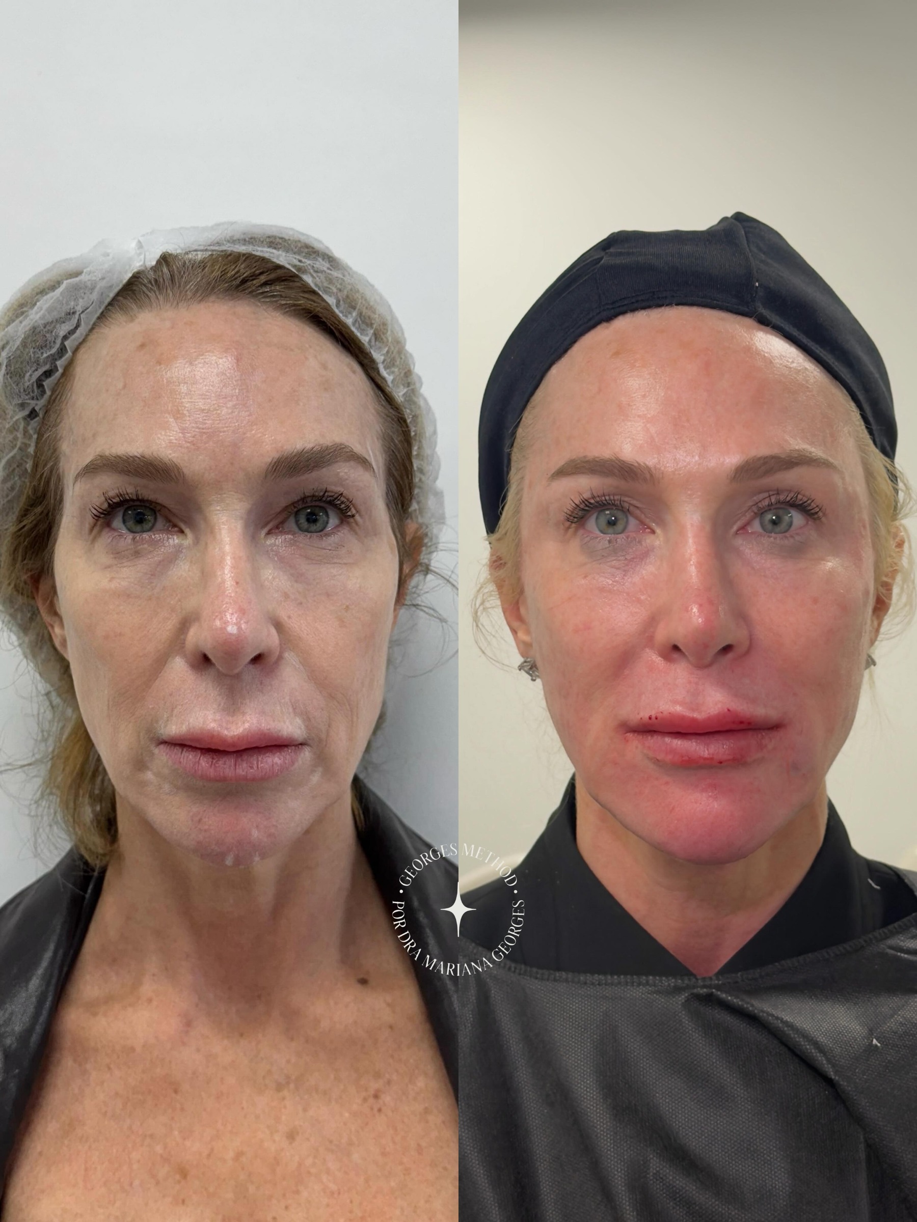 Antes e depois de harmonização facial