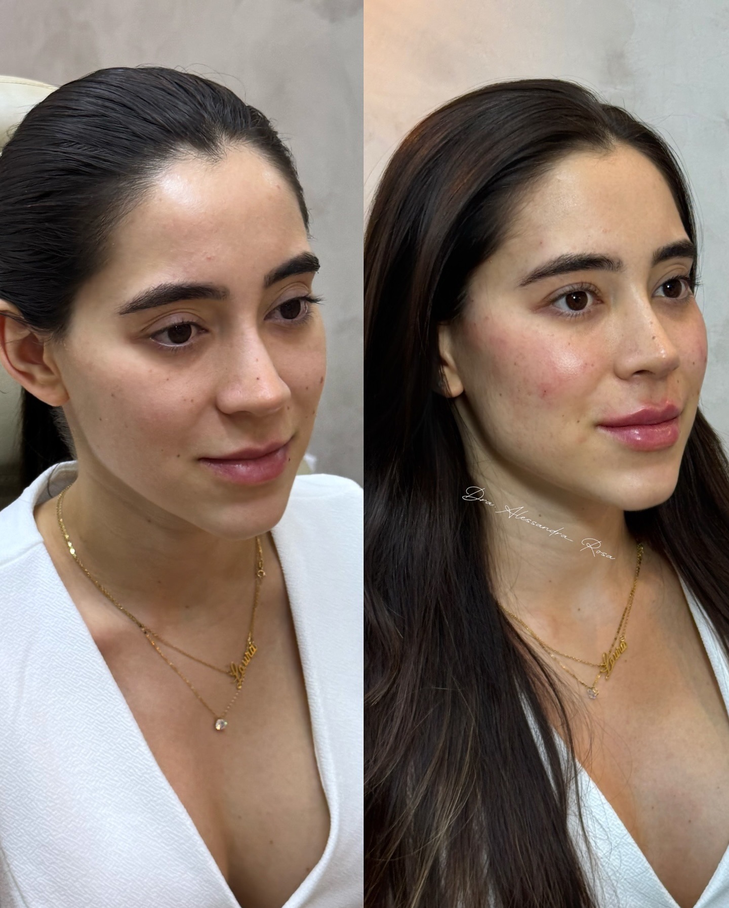 Antes e depois de harmonização facial