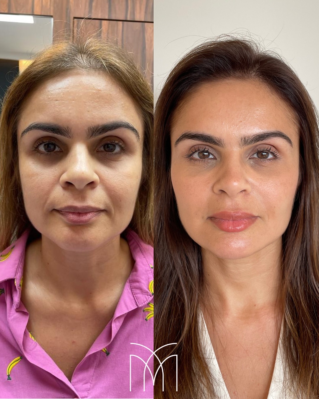 Antes e depois de harmonização facial